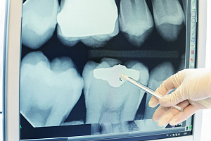 Цифровые снимки зубов против пленочных